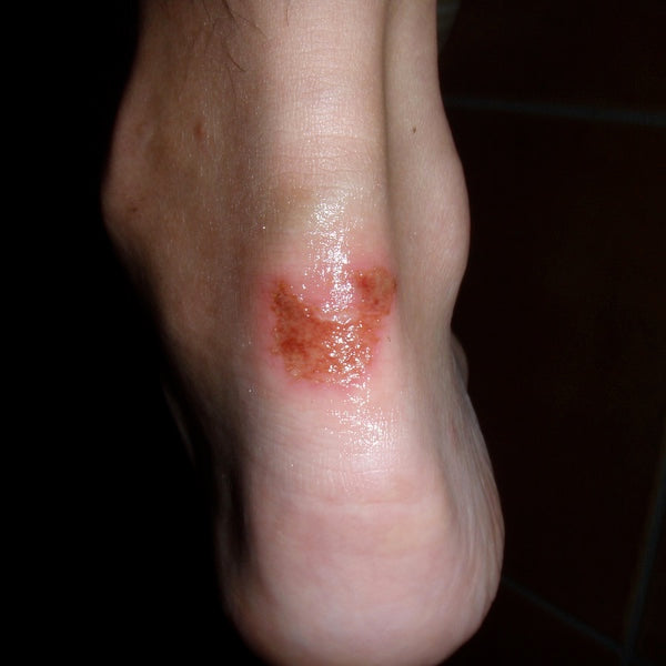 Blister Prevention on Multi-Day Dive Trips